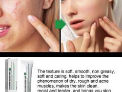 EELHOE Acne & Blemish Cream Lightens Blemishes & Acne Brightens Skin Complexion Moisturizing Skin Repair Cream