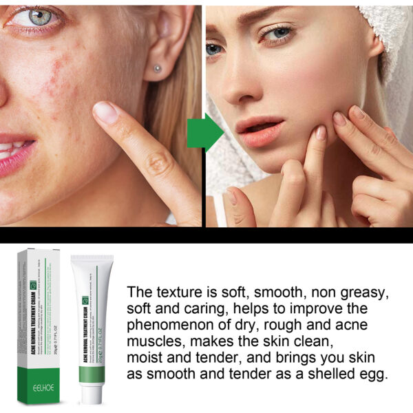 EELHOE Acne & Blemish Cream Lightens Blemishes & Acne Brightens Skin Complexion Moisturizing Skin Repair Cream